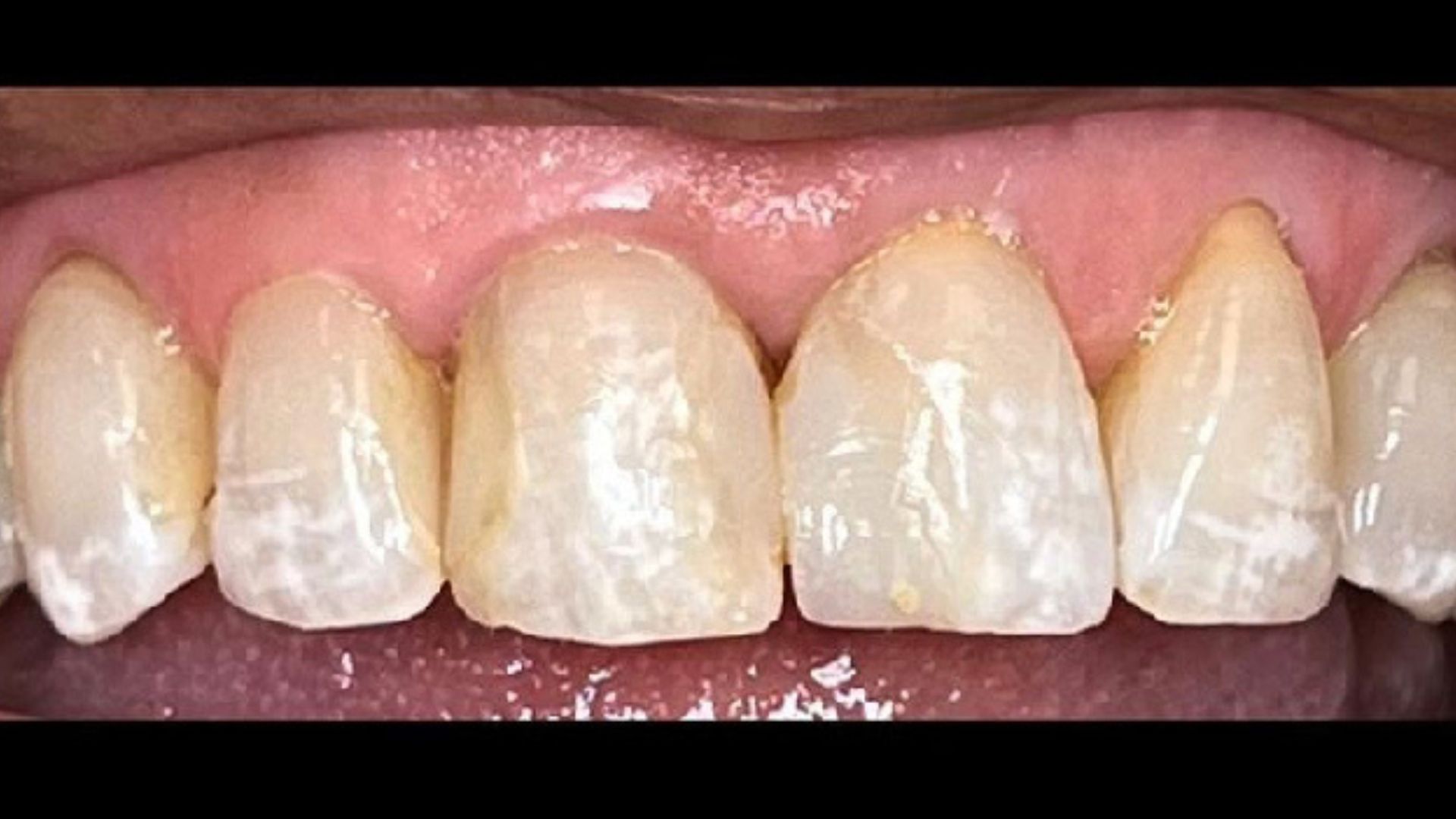 Kind Dental NJ - Smile Gallery