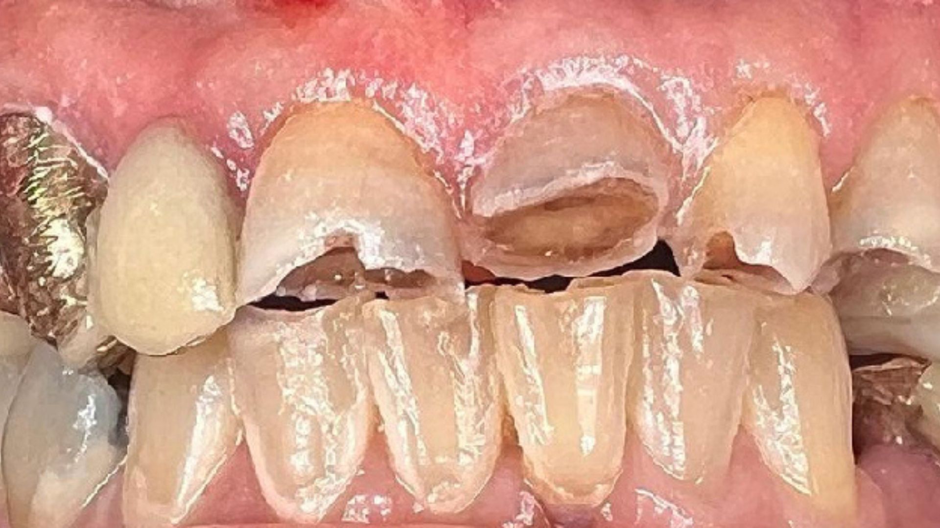 Kind Dental NJ - Smile Gallery