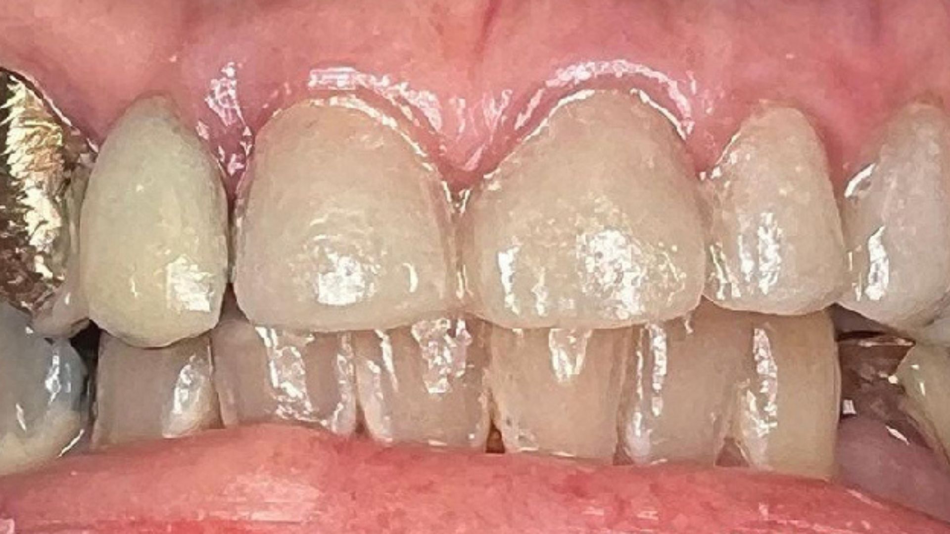 before and after 2