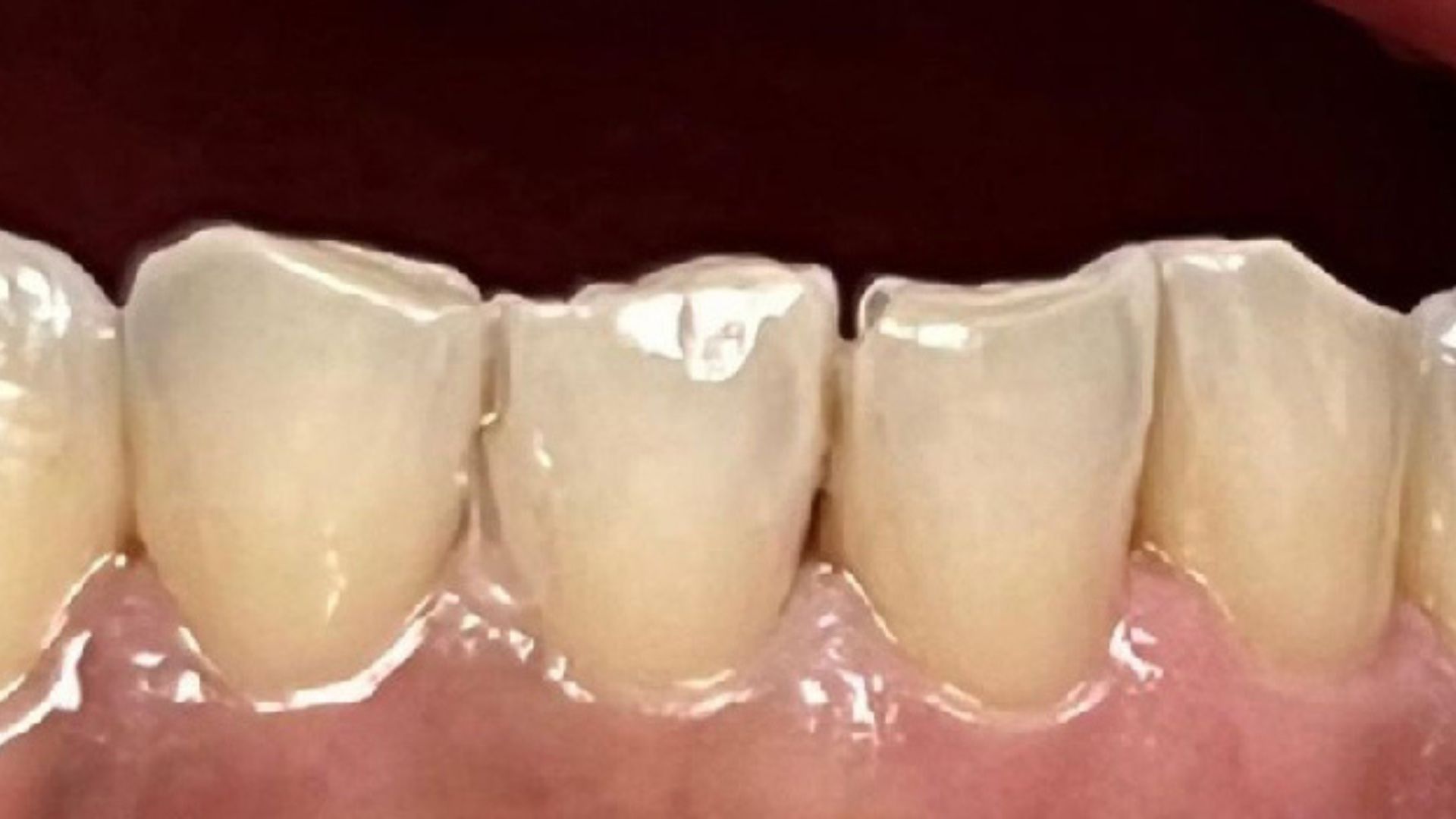Kind Dental NJ - Smile Gallery