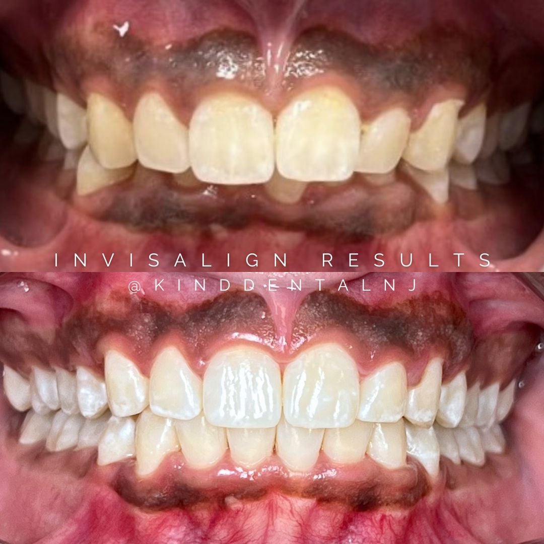 Invisalign Before and After