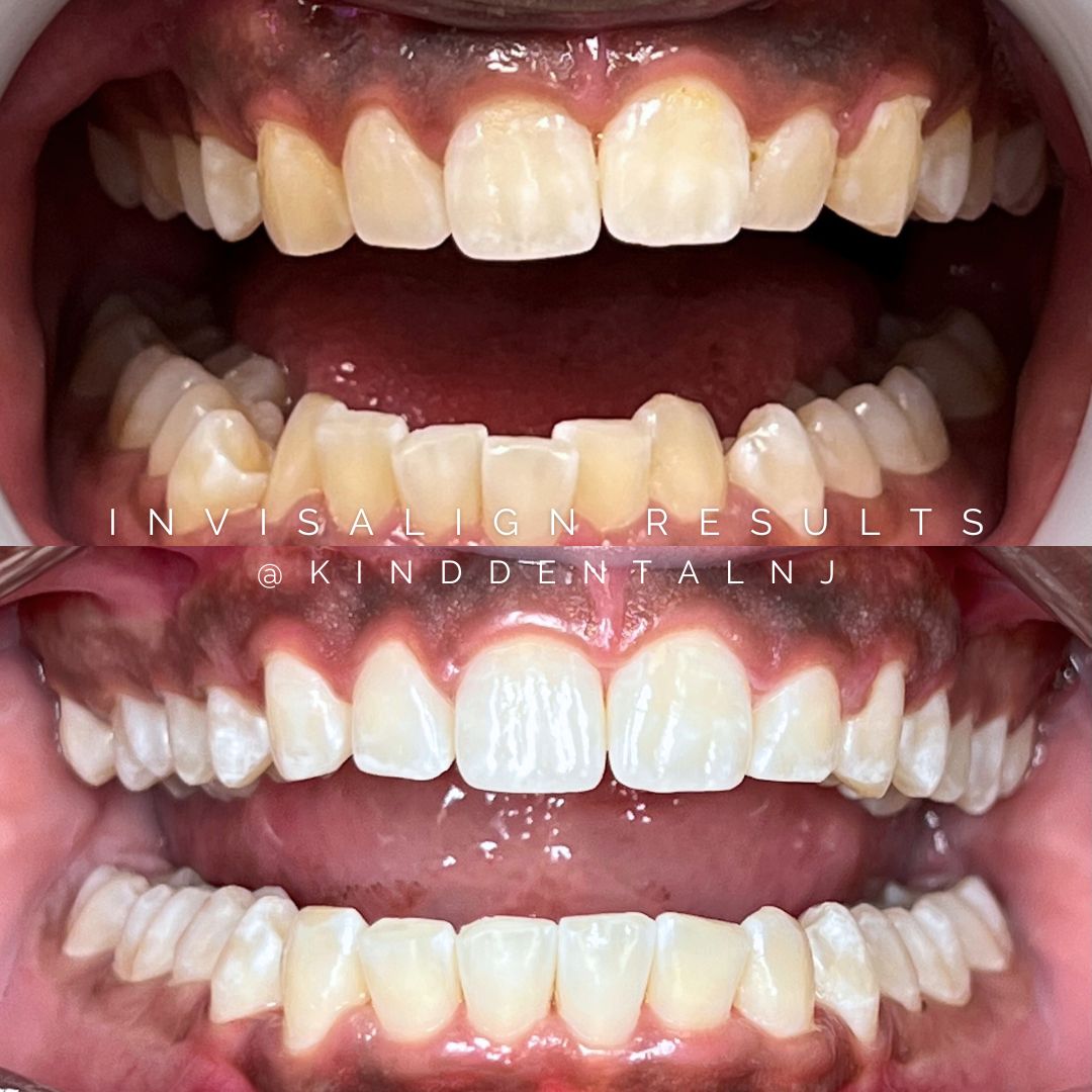 Invisalign Before and After