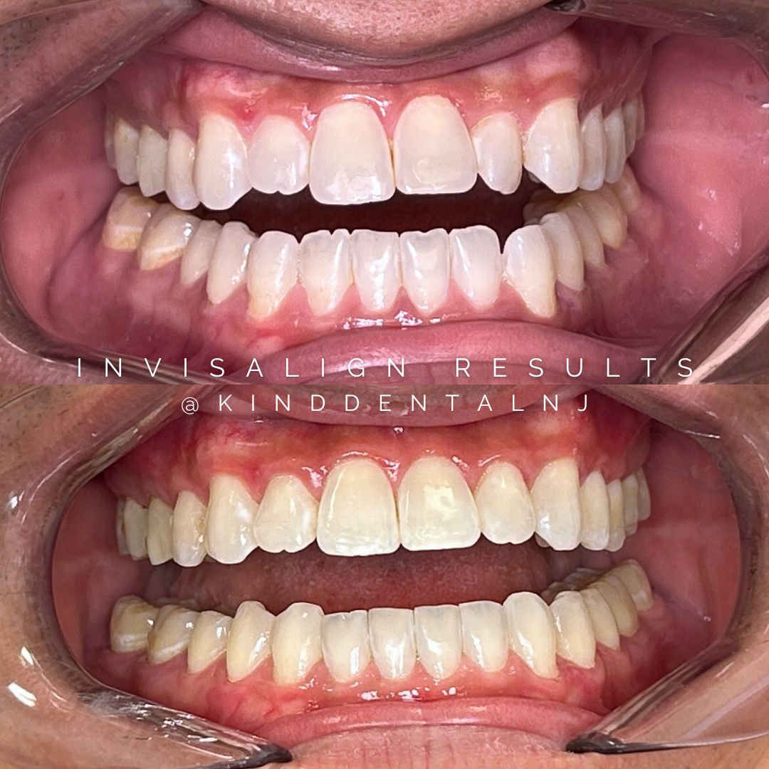 Invisalign Before and After