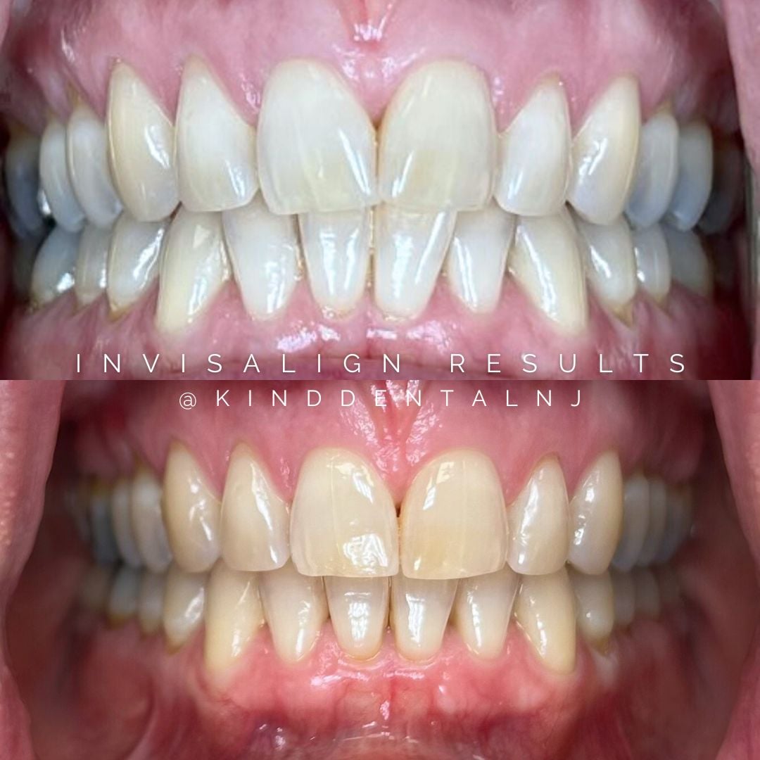 Invisalign Before and After
