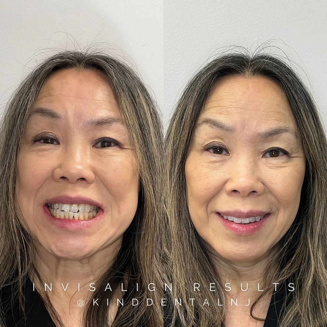 Invisalign Before and After