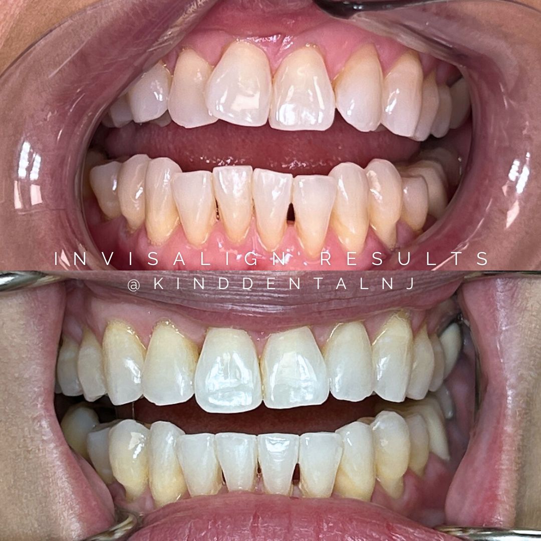 invisalign dentist scotch plains