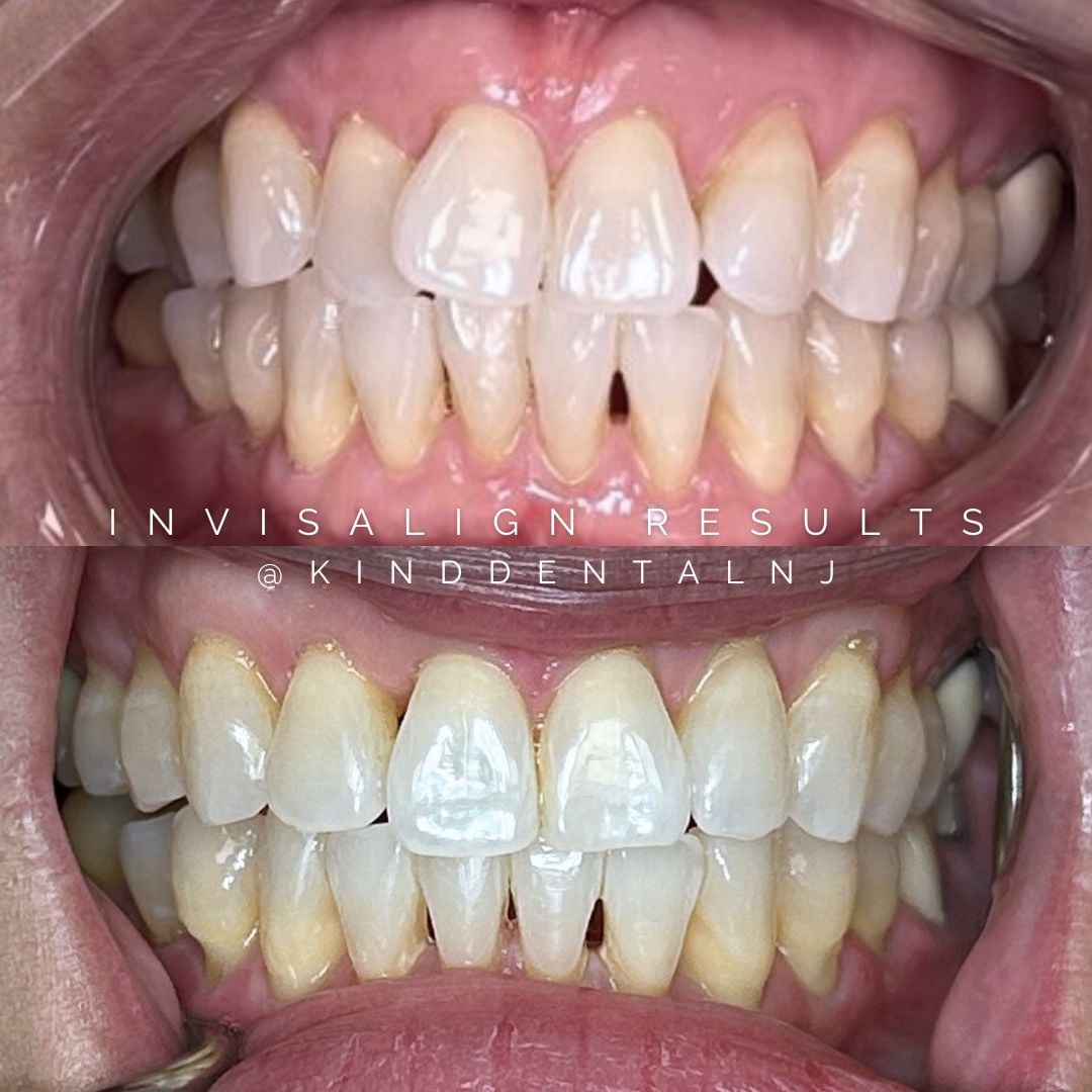 invisalign before after scotch plains
