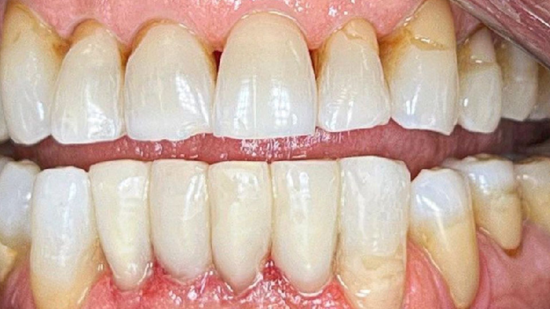 Kind Dental NJ - Dental Bonding