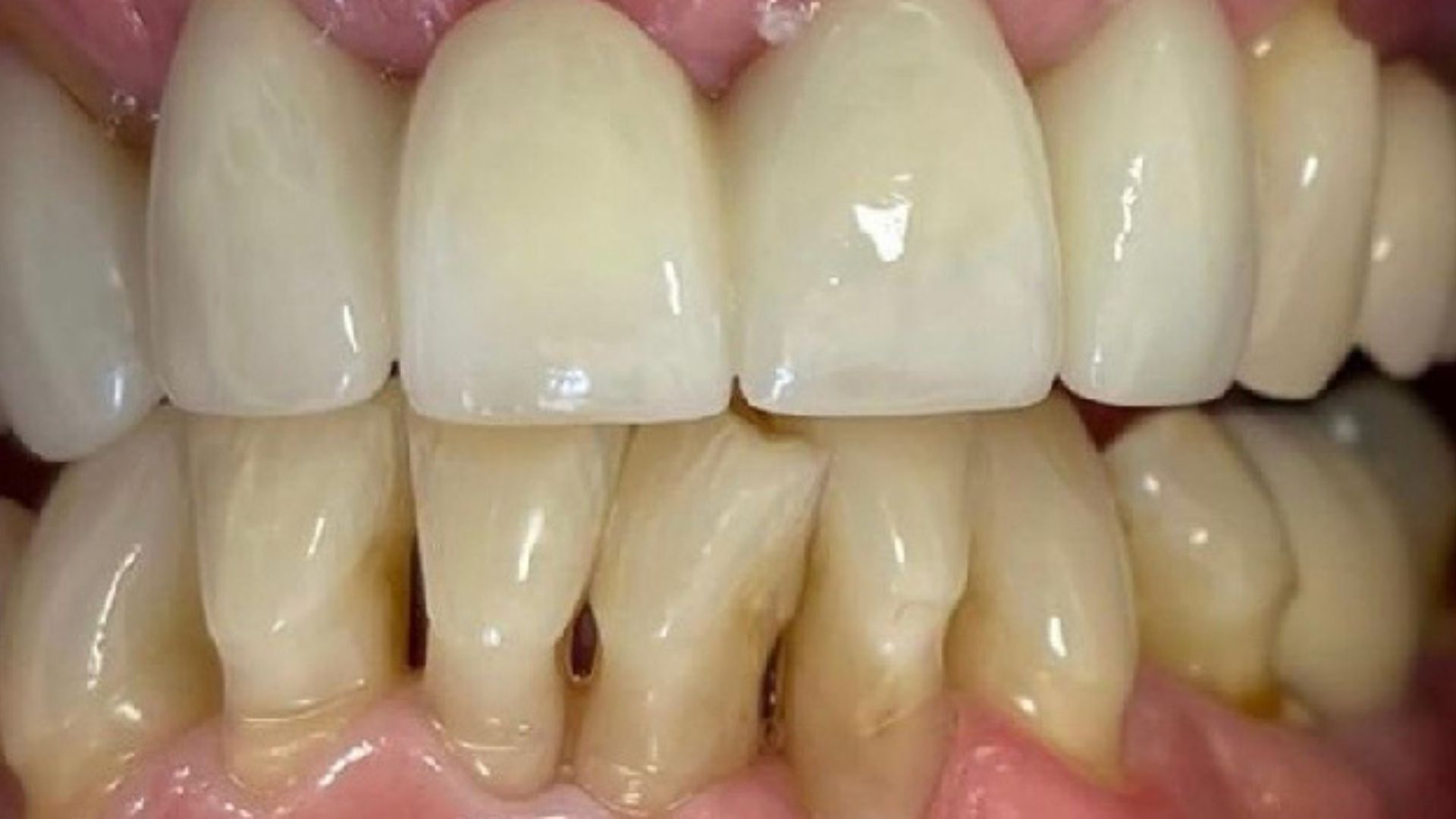 Kind Dental NJ - Dental Bonding