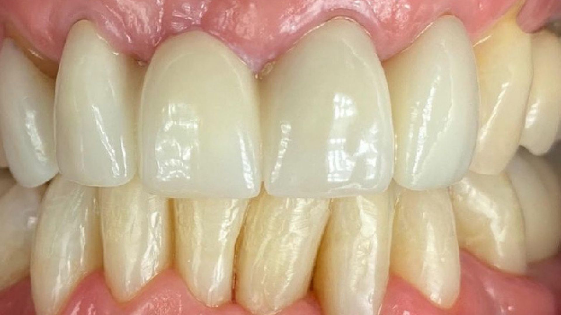 Kind Dental NJ - Dental Bonding
