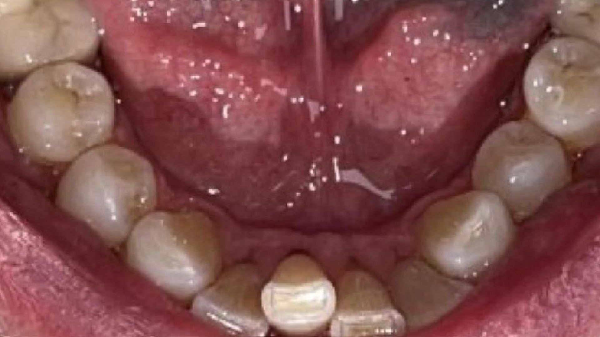 Kind Dental NJ - Dental Bonding