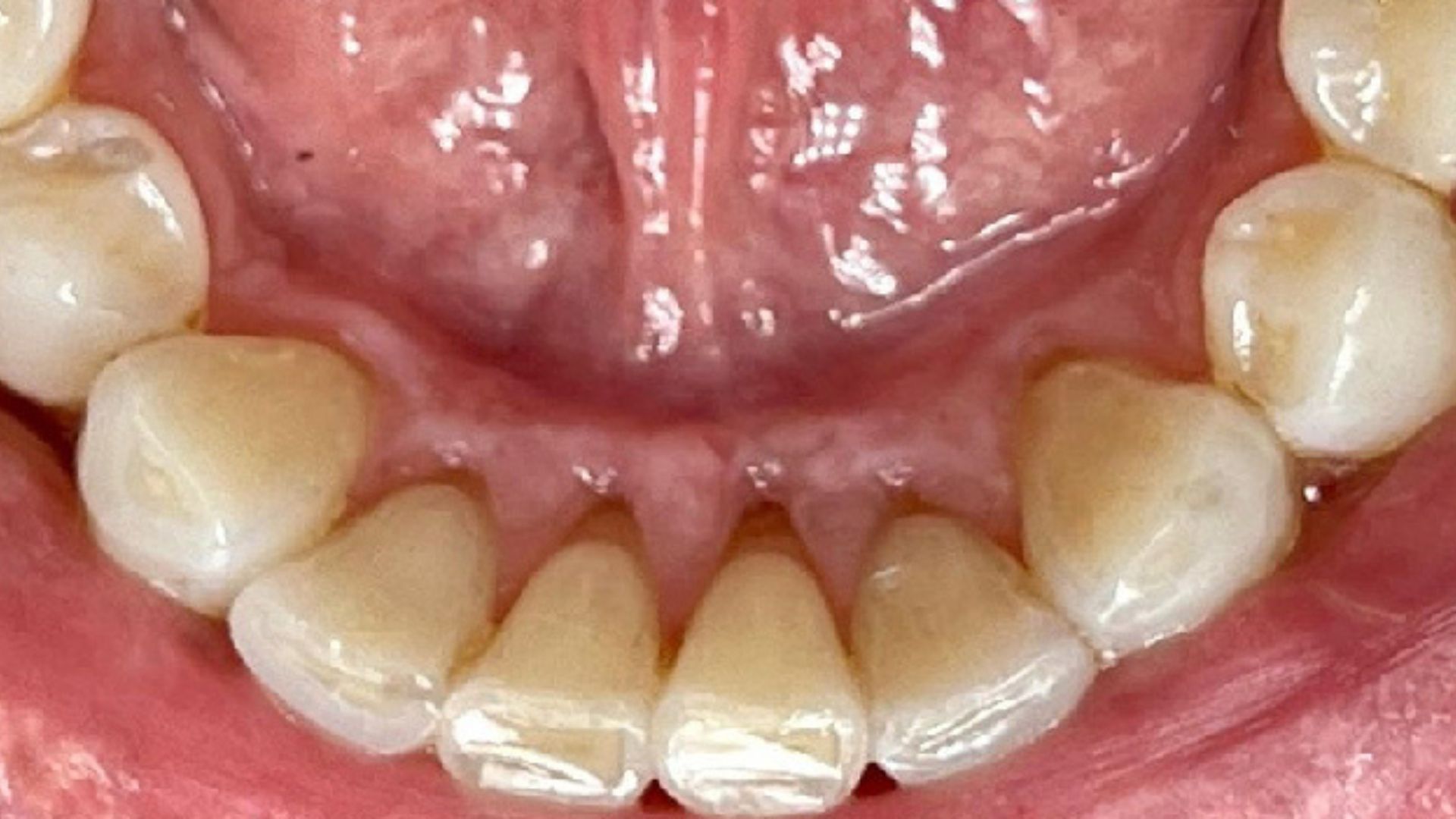 Kind Dental NJ - Dental Bonding