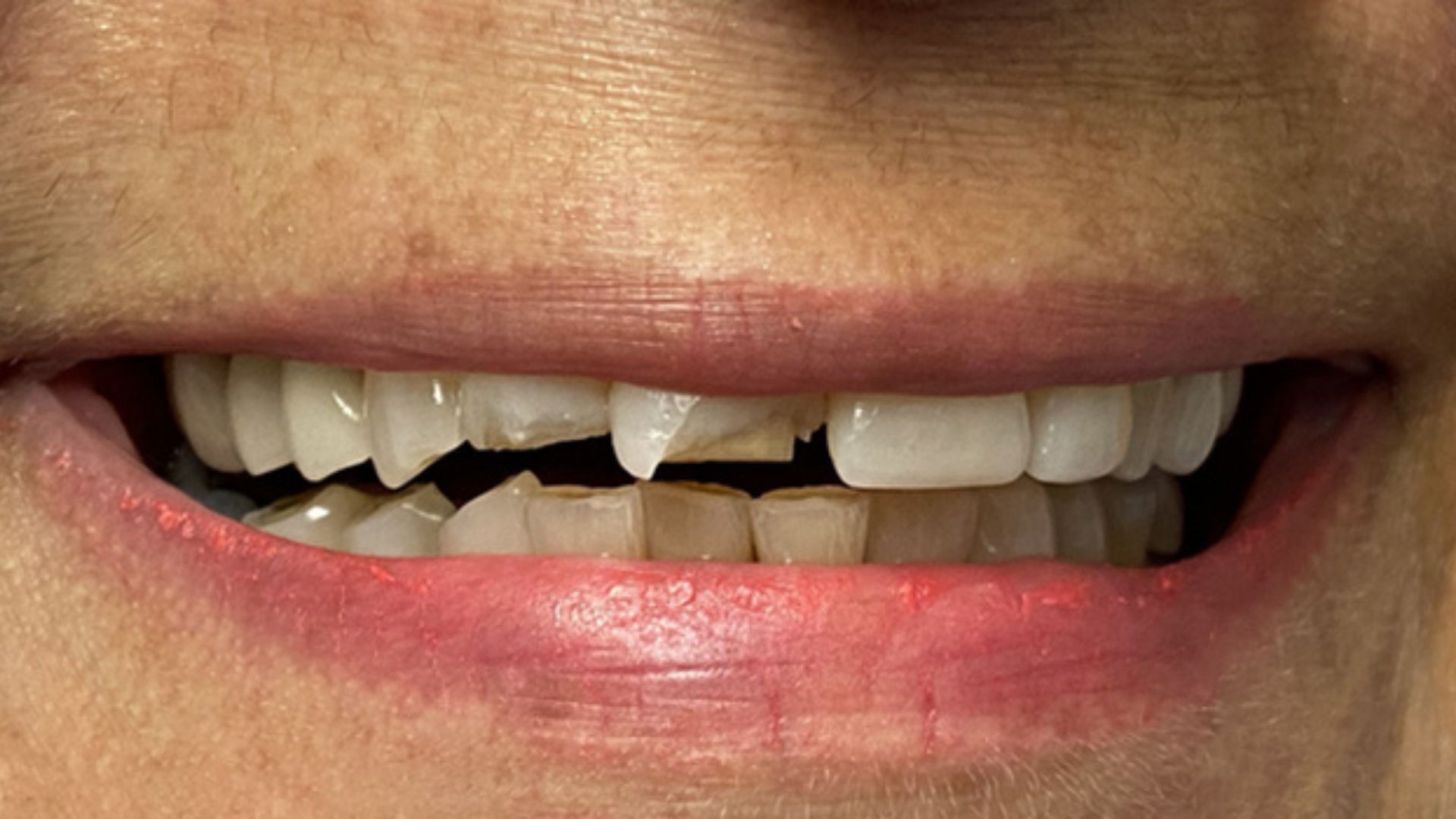 Kind Dental NJ - Dental Bonding