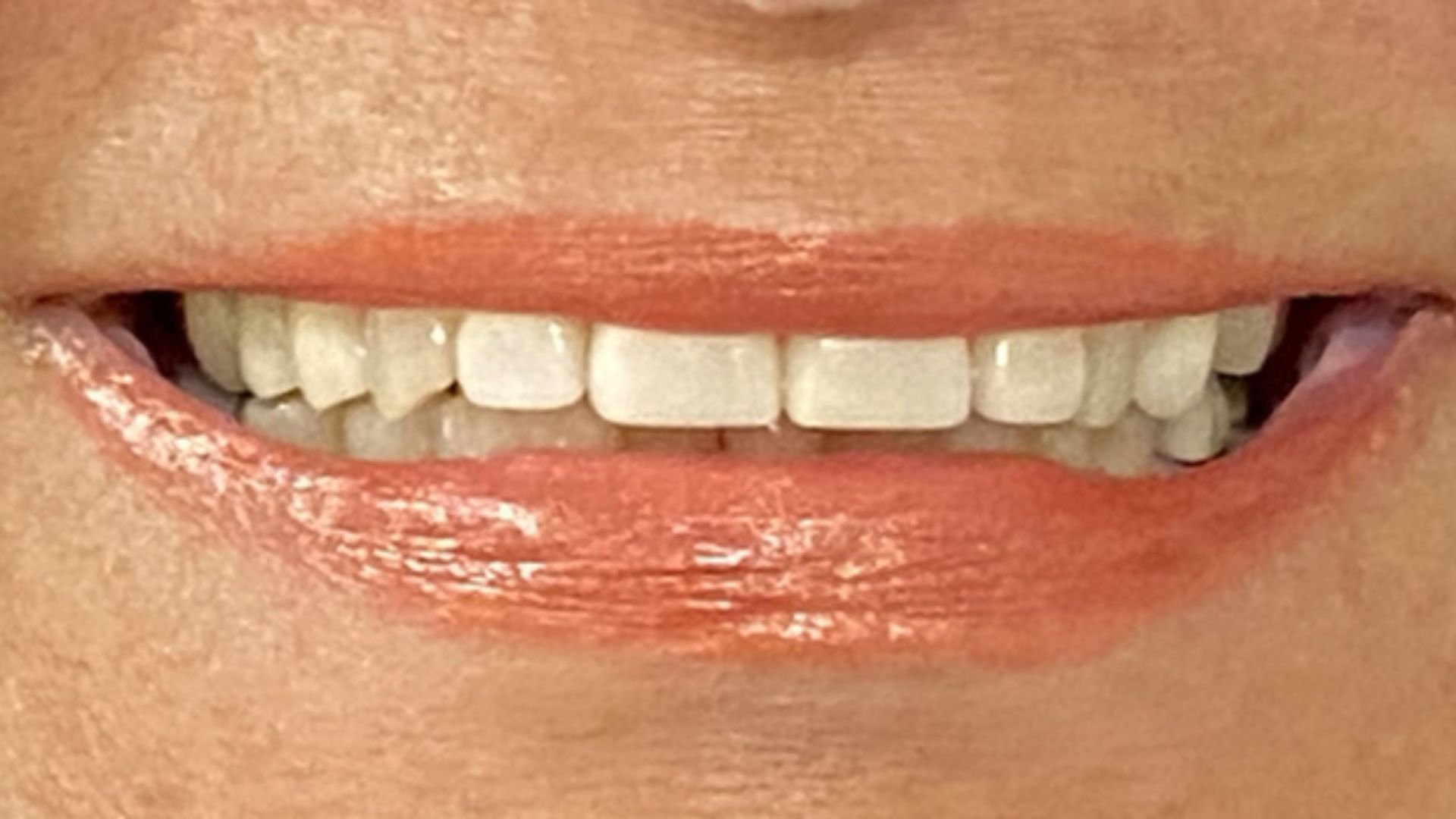 Kind Dental NJ - Dental Bonding