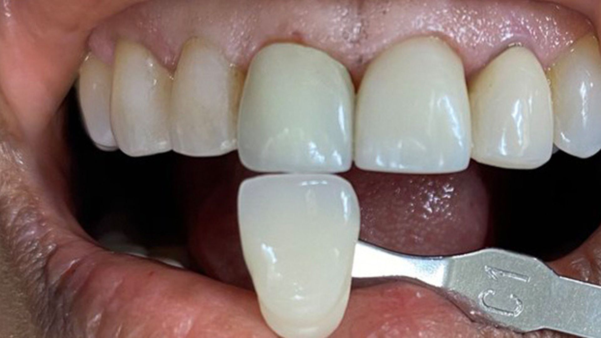 Kind Dental NJ - Dental Bonding