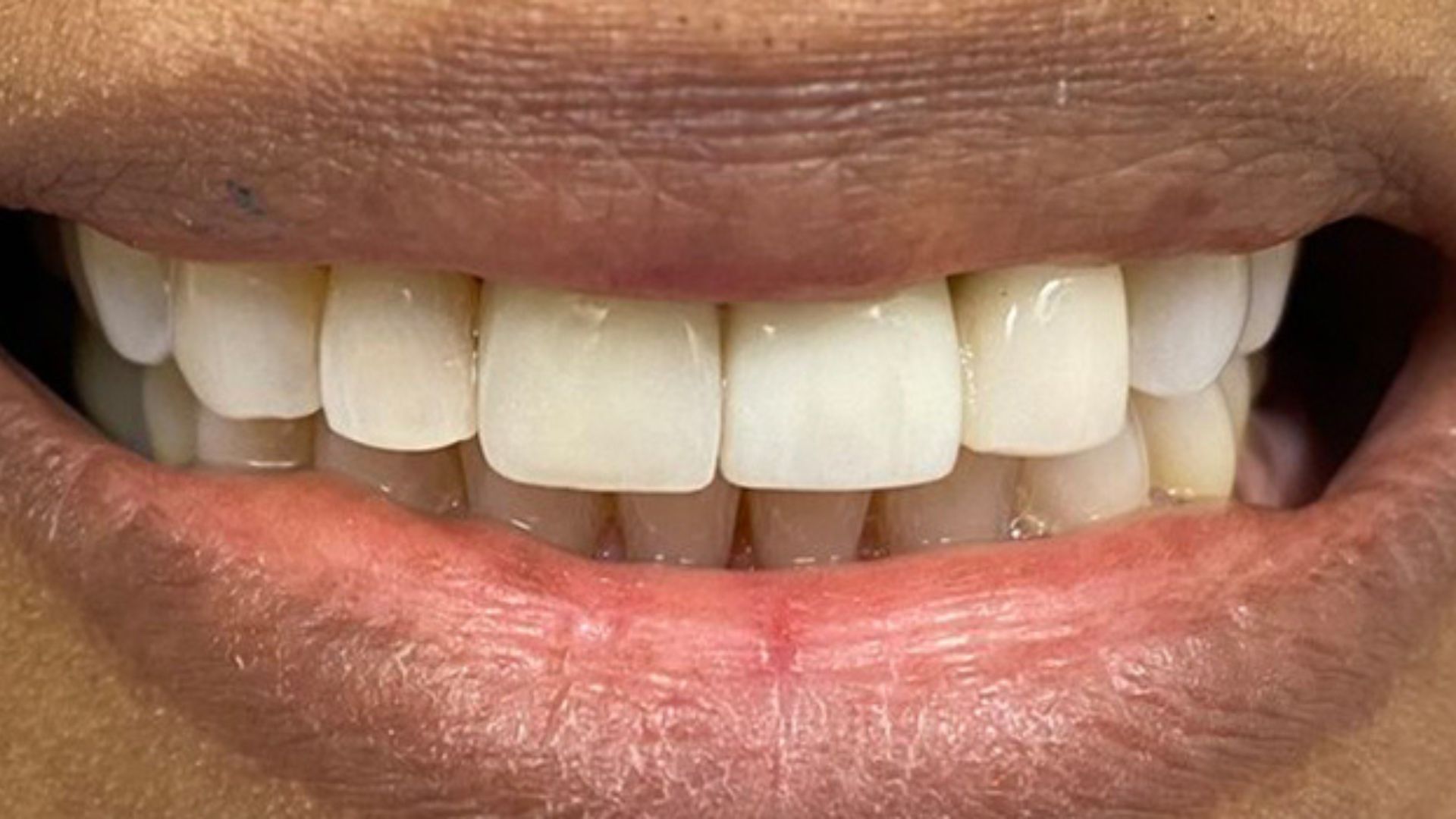 Kind Dental NJ - Dental Bonding