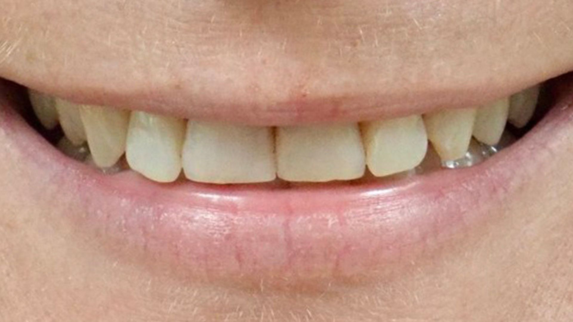 Kind Dental NJ - Dental Bonding