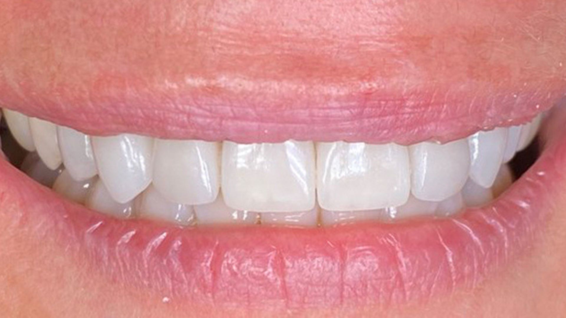 Kind Dental NJ - Dental Bonding