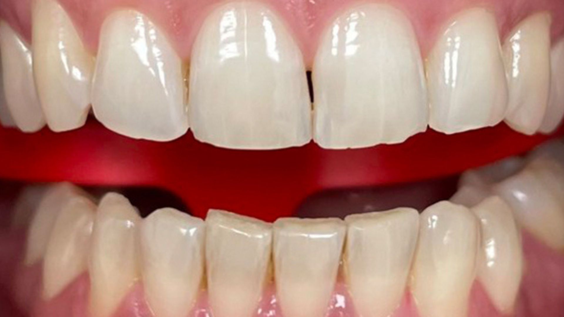 Kind Dental NJ - Dental Bonding