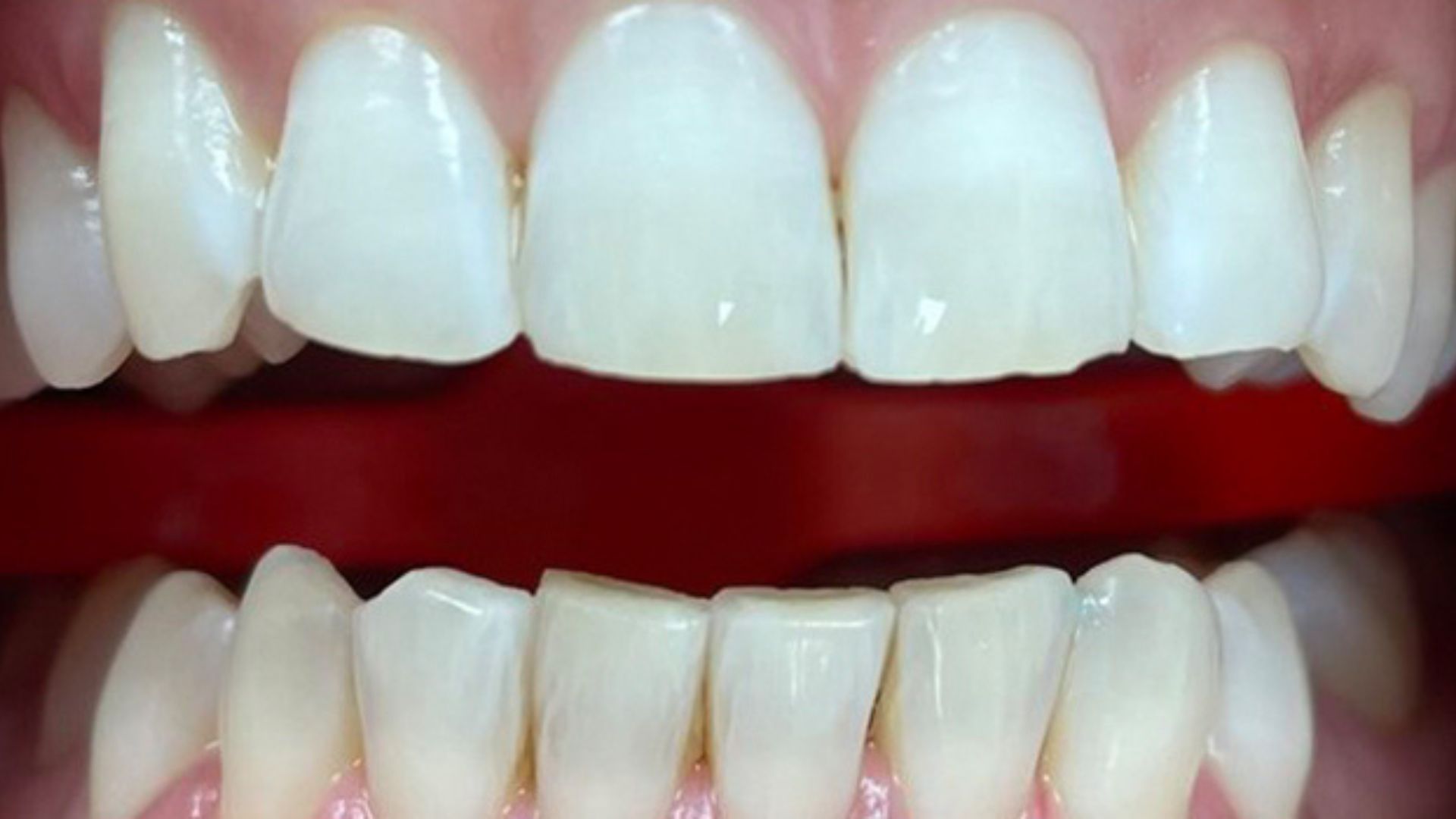 Kind Dental NJ - Dental Bonding