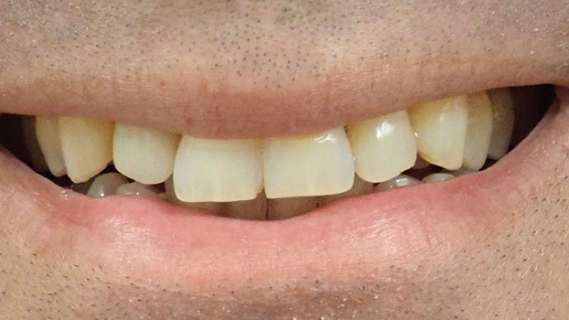 Kind Dental NJ - Dental Bonding