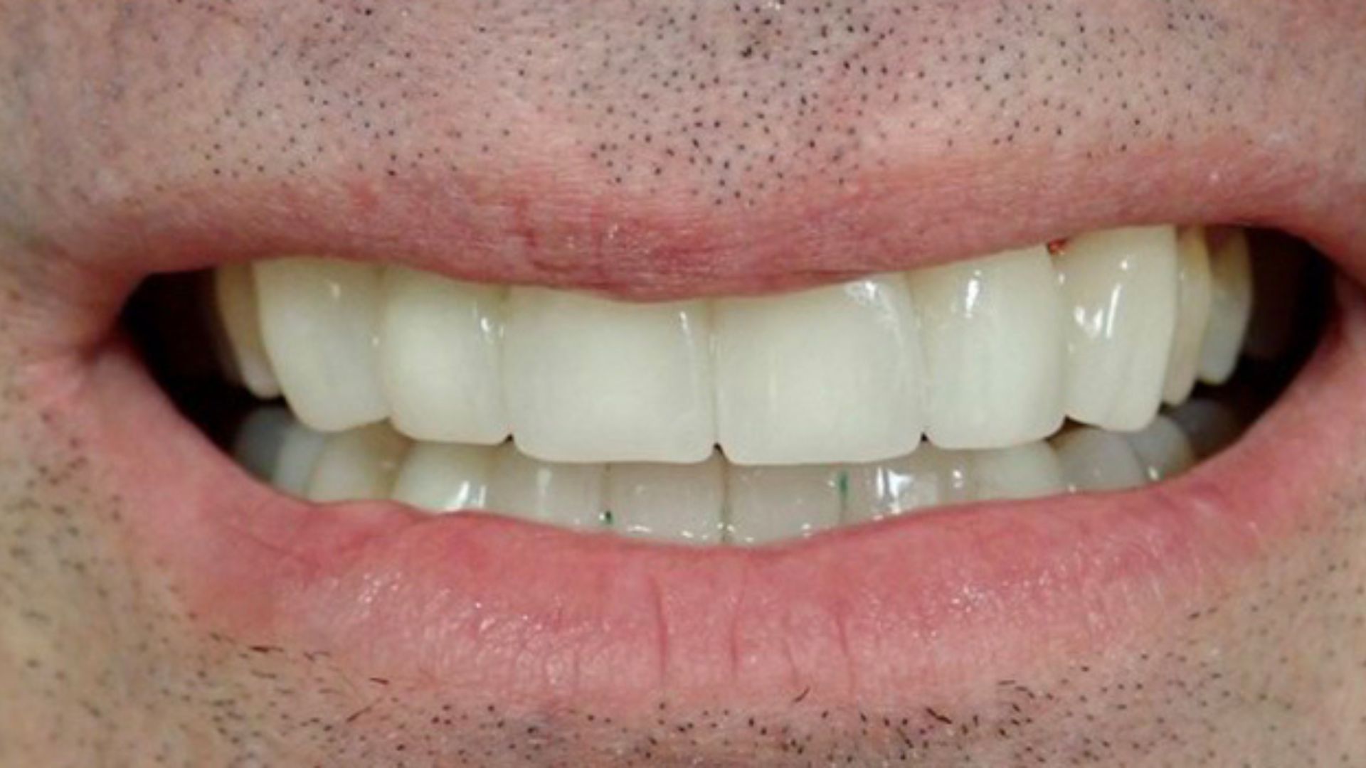 Kind Dental NJ - Dental Bonding
