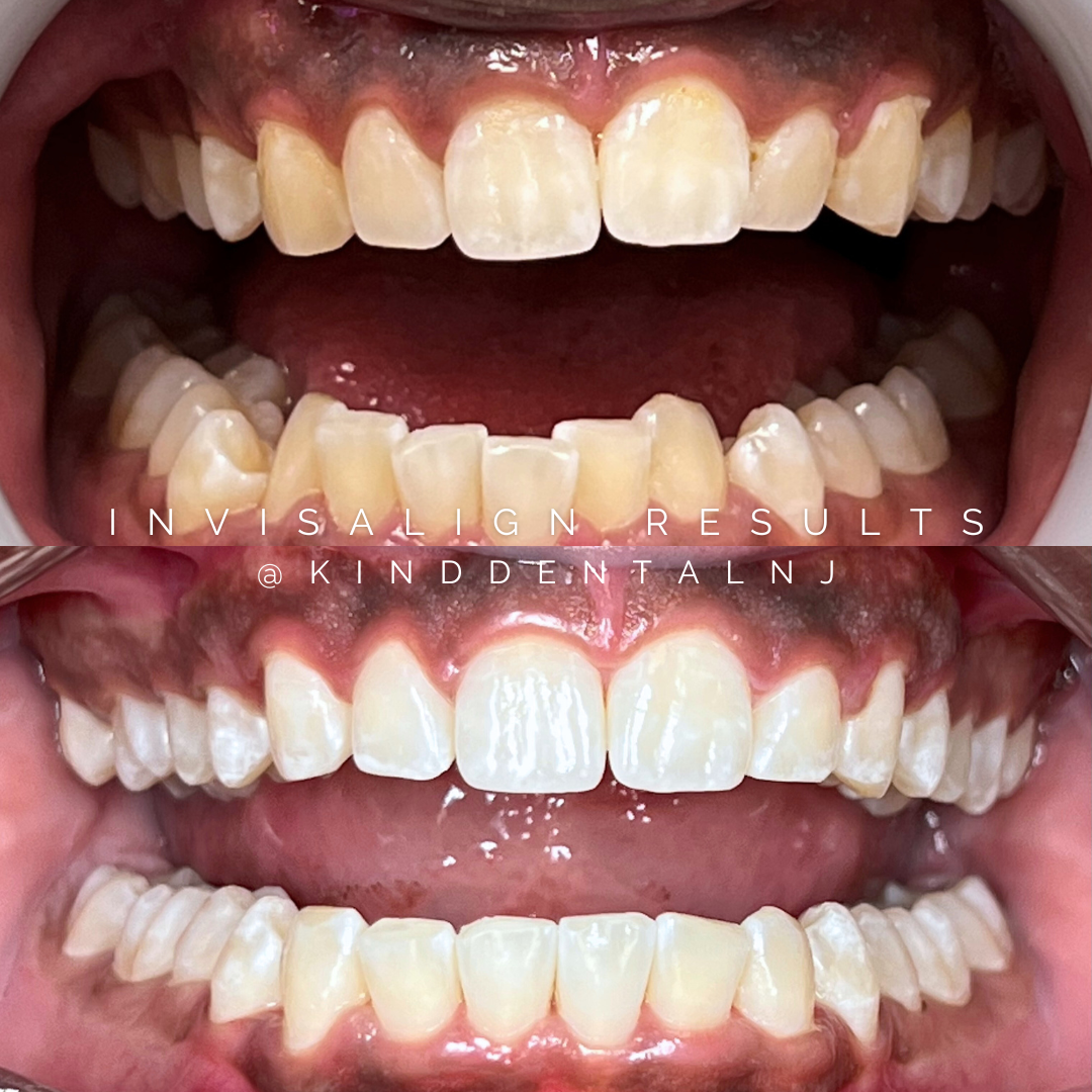 Invisalign Before and After