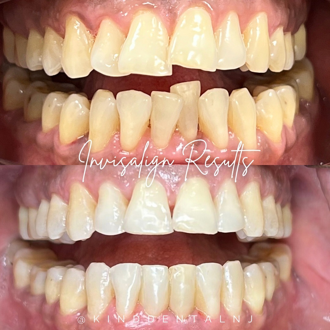 Invisalign Before and After