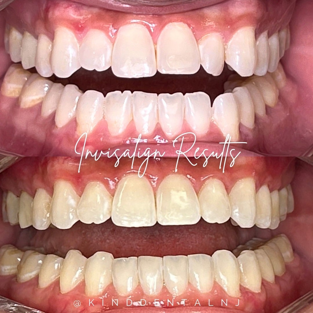 Invisalign Before and After