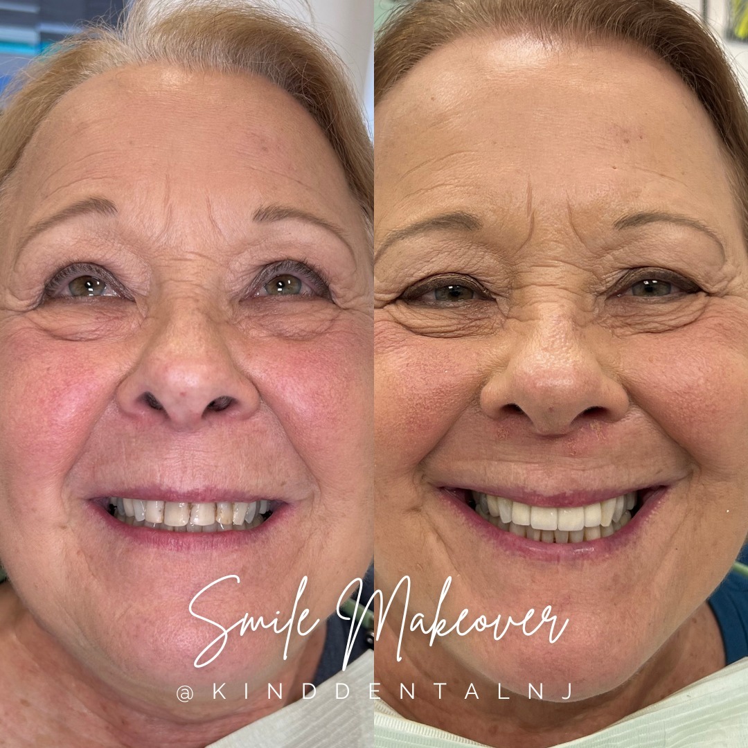 Smile Makeover Treatment at Kind Dental