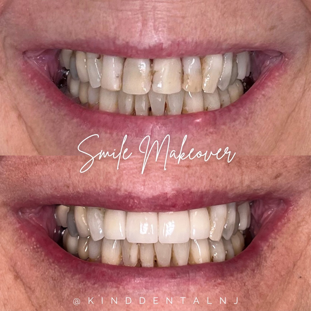 Kind Dental NJ - Smile Gallery