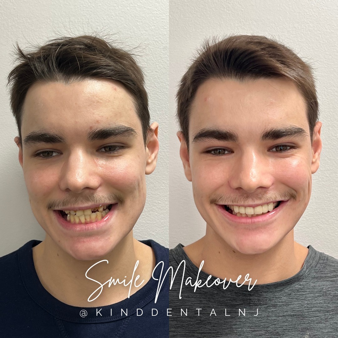 Smile Makeover Treatment at Kind Dental