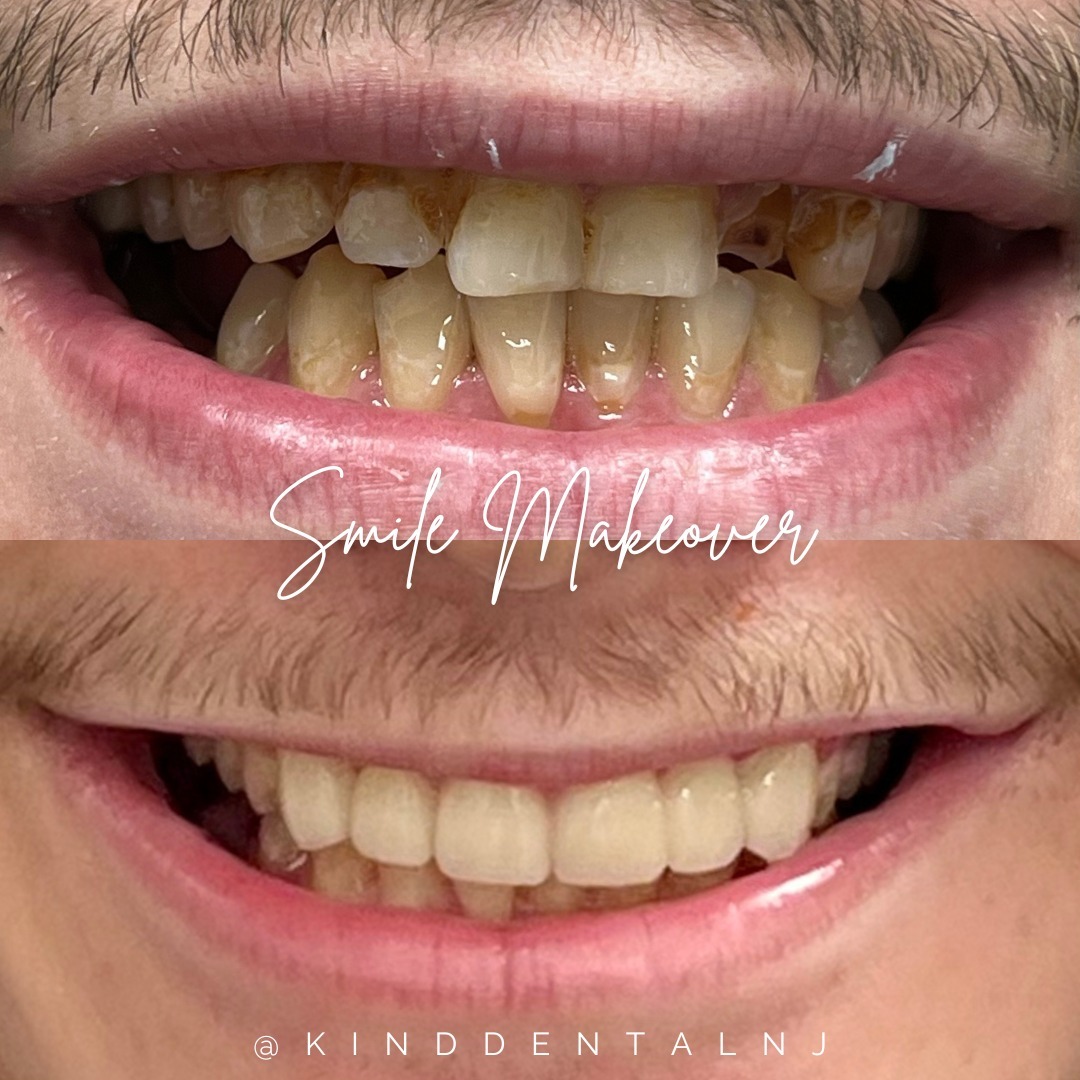 Kind Dental NJ - Smile Gallery
