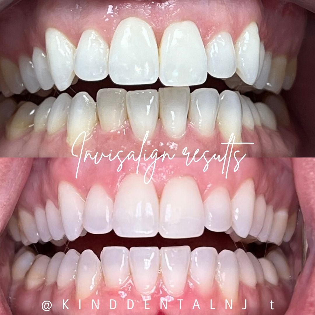 Kind Dental NJ - Our Blog