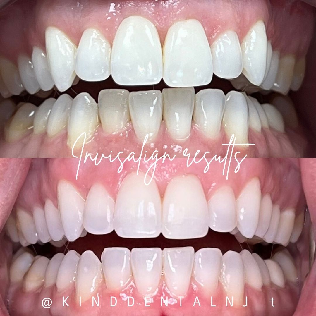 Invisalign Kind Dental