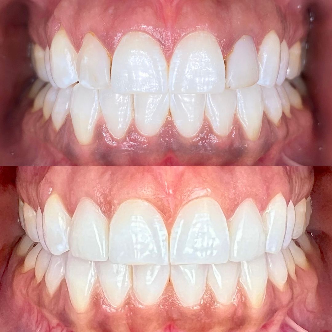 Kind Dental B&A's for Website (4)