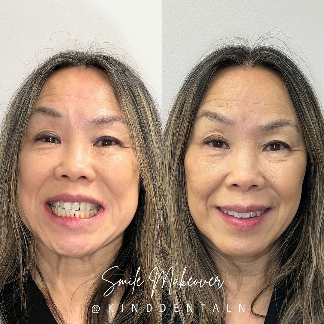 Kind Dental B&A's for Website (6)