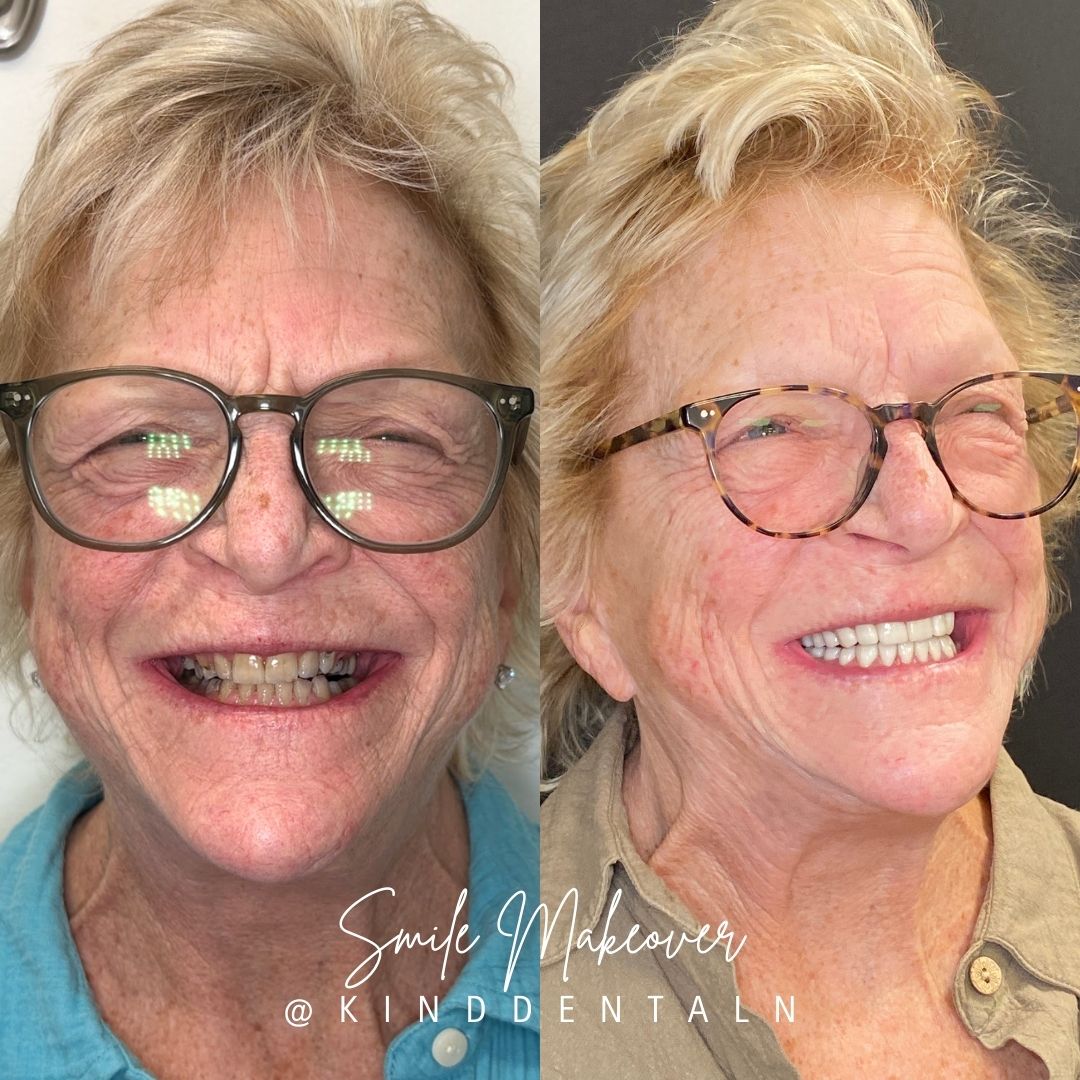 Kind Dental B&A's for Website (6)