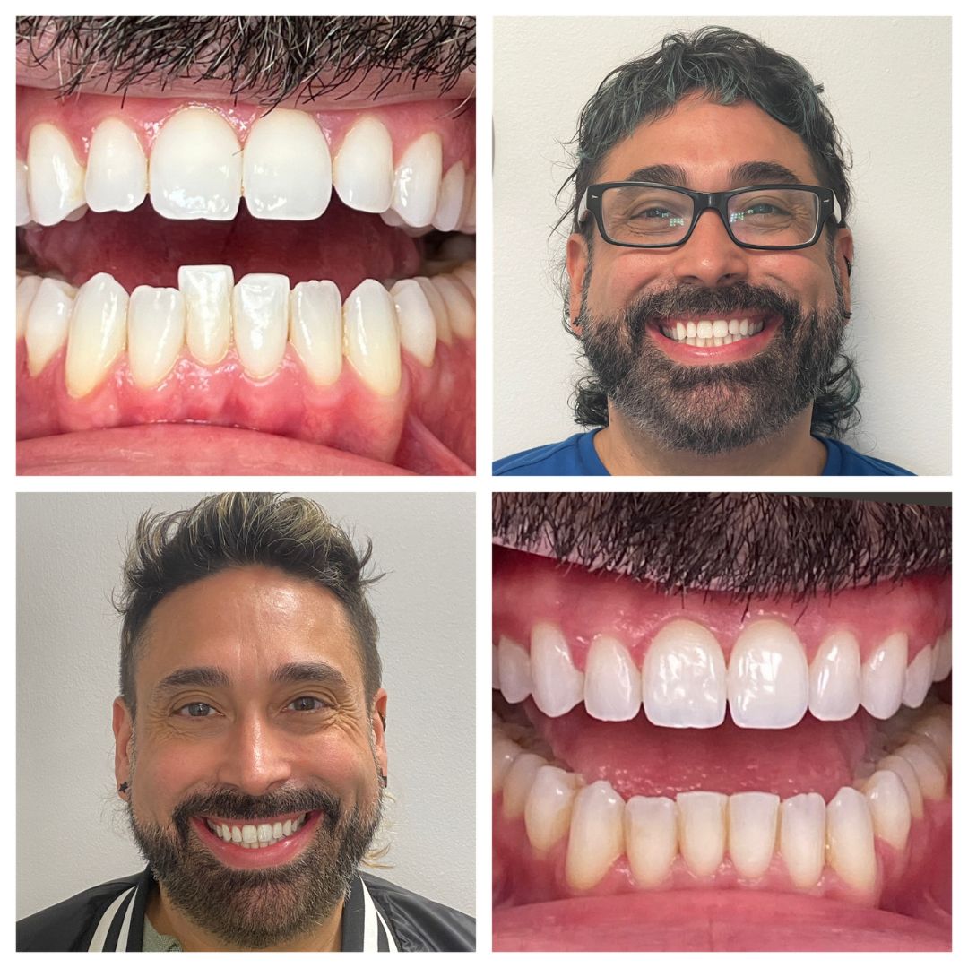 invisalign before after scotch plains